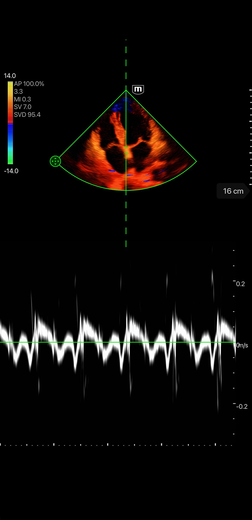 Doppler tisular