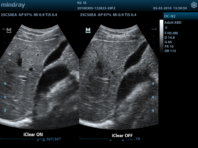 Liver GB iClear white