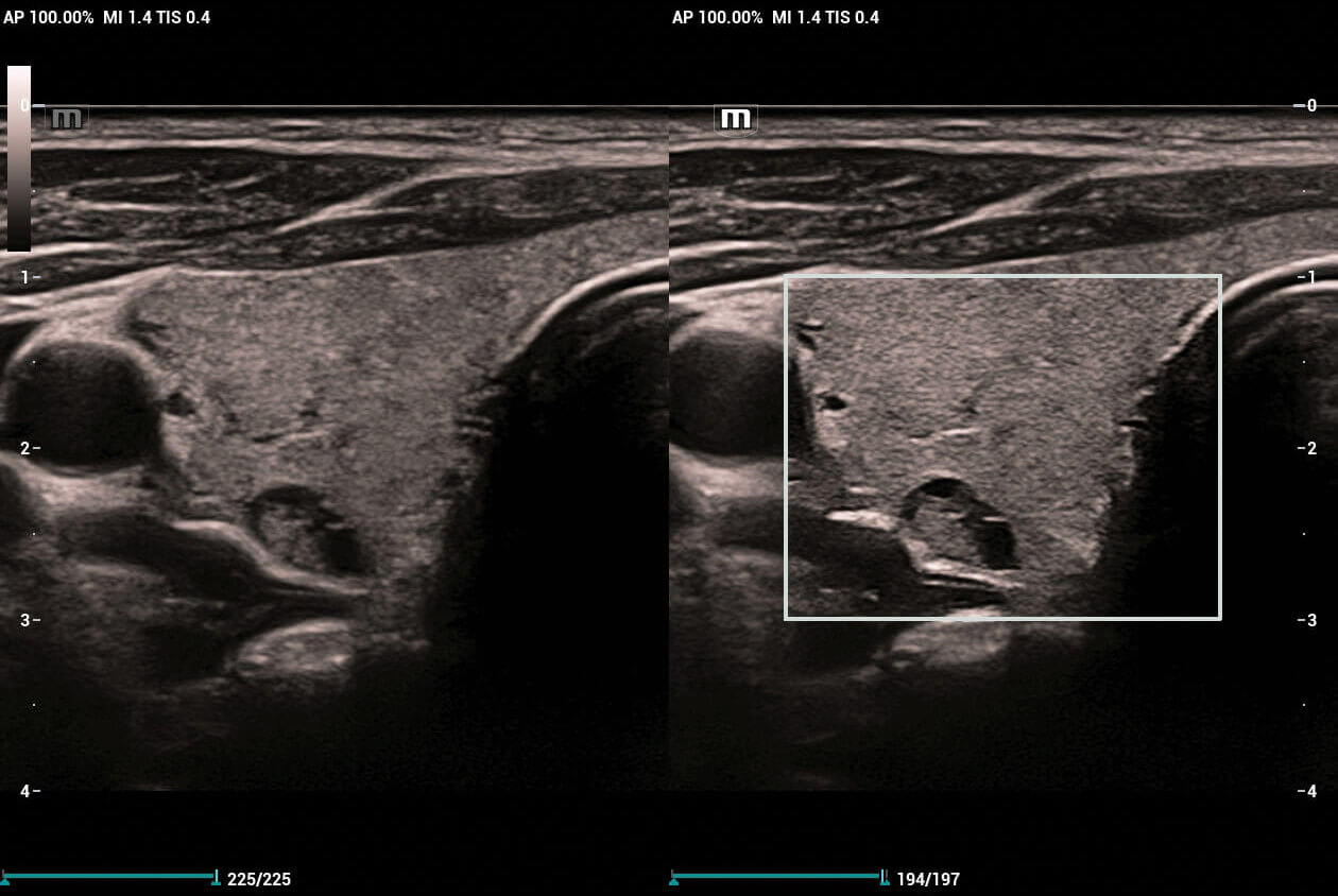 HD-Scope-of-Complex-Thyroid-Lesion-2