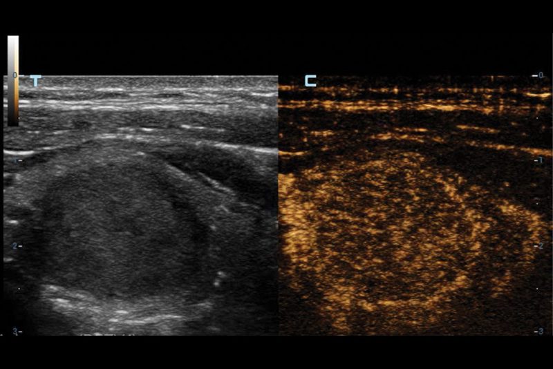 High-Frame-Rate-CEUS-of-Thyroid-Lesion-2-800x534