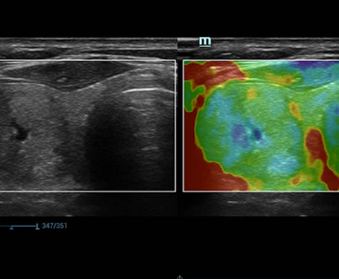 Elastography of Thyroid Mass