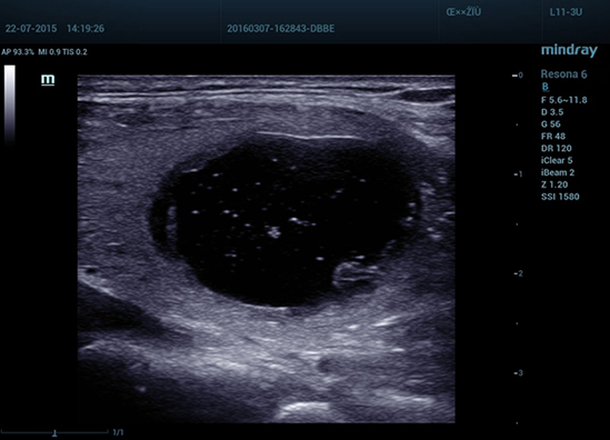 04 Thyroid Mass