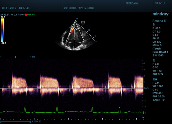 11 Mitral Stenosis