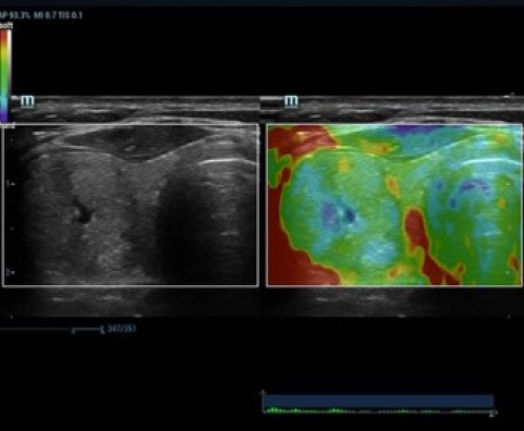 Elastography of Thyroid Mass