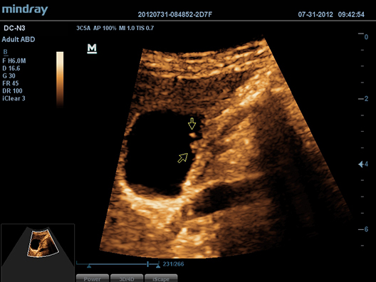 Adult Gall Bladder Polyp