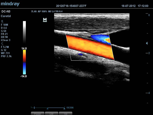 Carotid Artery and Jugular Vein