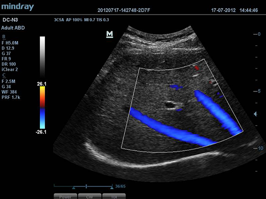 Hepatic Vein flow