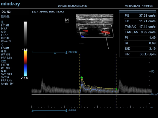 Vertebral Artery Palse Wave