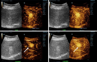 Genauere Diagnosen mit HiFR-CEUS