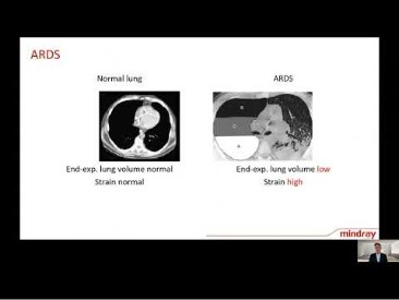 Lung Protective Ventilation Webinar