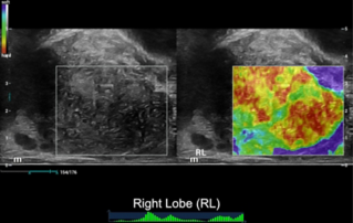 Ultrasound Journal 3 - A Case Sharing of Prostate Shearwave Elastography