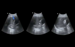 Ultrasound Journal 26 - Evaluation of the percutaneous radio-frequency thermal ablation zone using CEUS