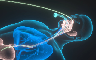 Lung protection ventilation during anaesthesia Clinical Information Leaflet