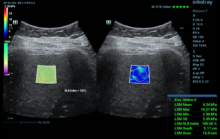 Ultrasound Journal 18 - Multiparametric Approach in Ultrasound Diagnosis of Metabolically Associated Fatty Liver Disease