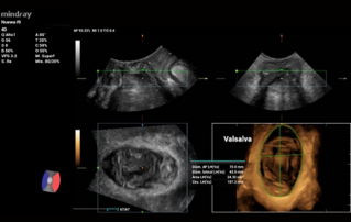 Ultrasound Journal 29 - Pelvic floor ultrasound application in the follow-up of prosthetic material in the management of stress urinary incontinence