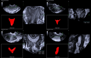 Ultrasound Journal 33 - Use of Smart ERA in diagnosis of Ultrasound Journal 33 - Use of Smart ERA in diagnosis of Müllerian duct abnormalities duct anomalies