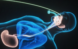 Lung protection ventilation during anaesthesia Clinical Information Leaflet