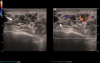 Ultrasound Journal 27 - Non-Hodgkin Lymphoma: The Great Simulator