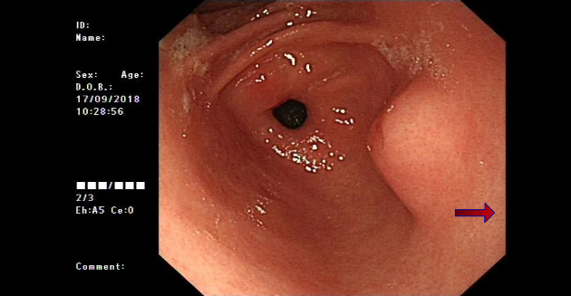 ectopic-pancreas-fig1-pc