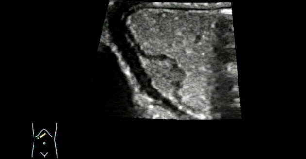 ectopic-pancreas-fig3-pc