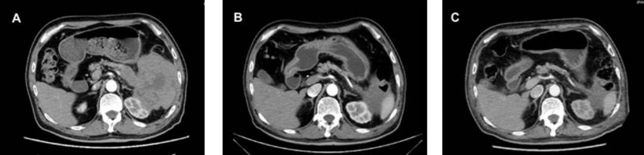 pancreatic-lymphoma-fig4-pc