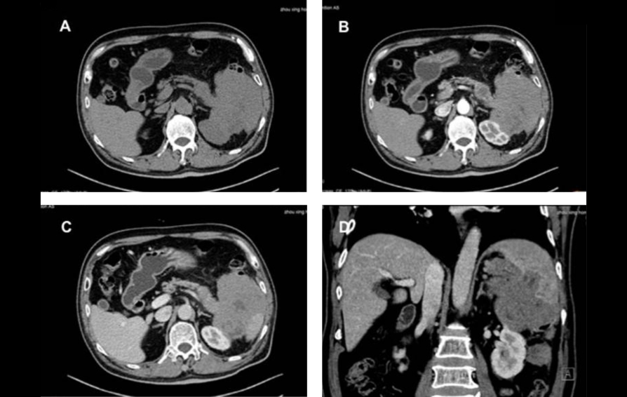 pancreatic-lymphoma-kv-pc