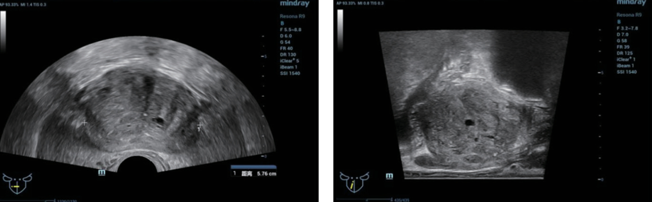 trus-mri-fusion-fig1-pc