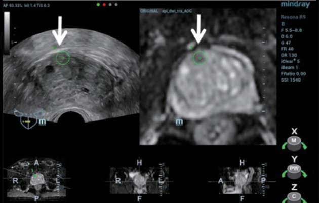 trus-mri-fusion-fig4-pc