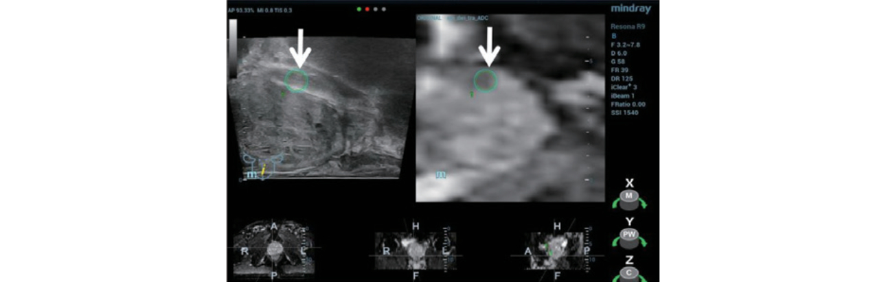 trus-mri-fusion-fig6-pc