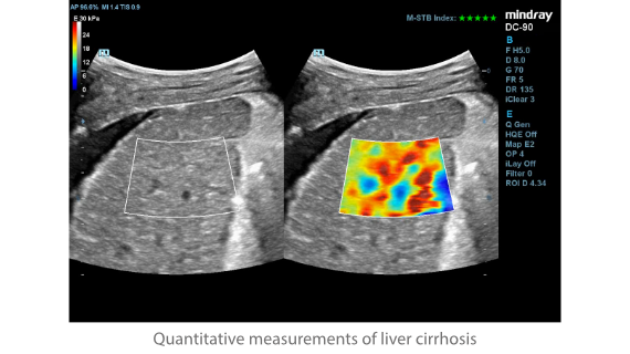 DC-90 rad STE liver-cirrhosis SC6-1E