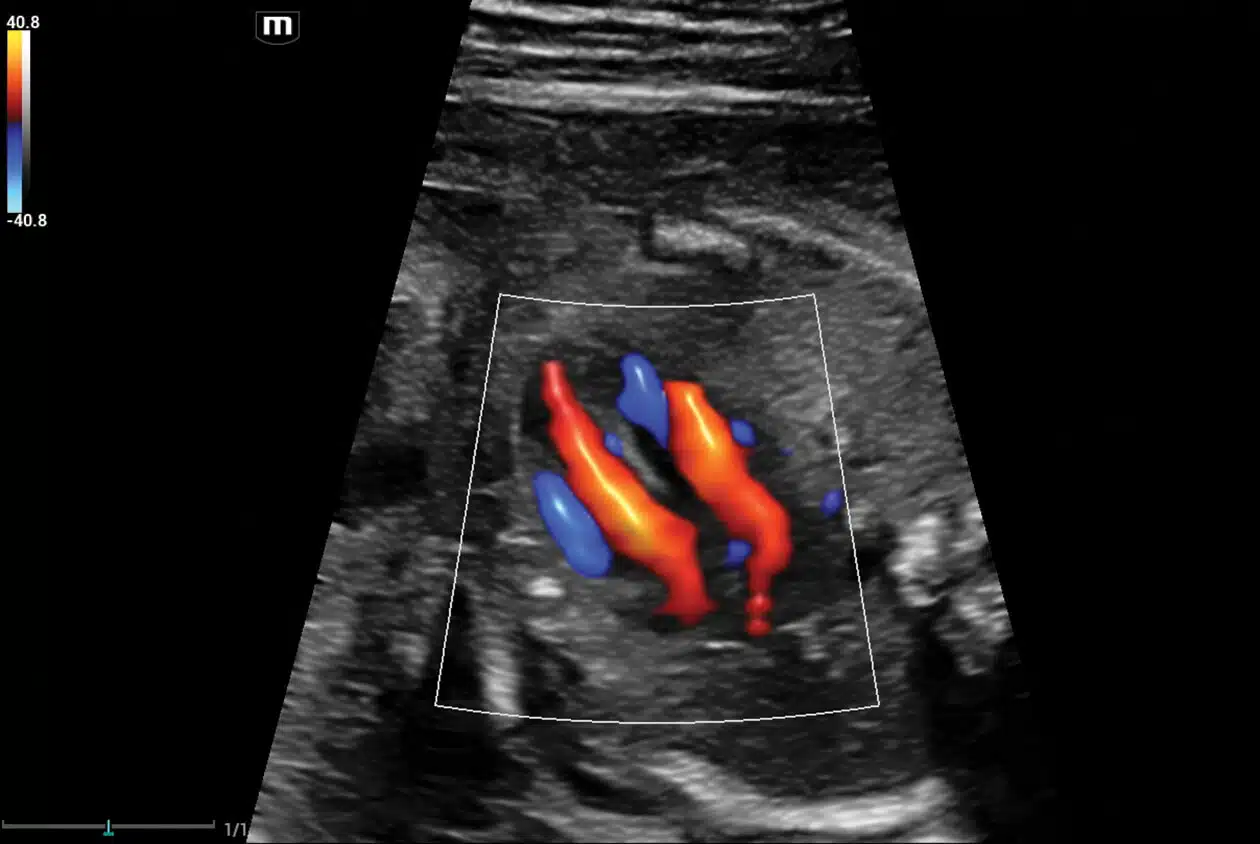 Glazing-FLow-Fetal-Heart.jpg