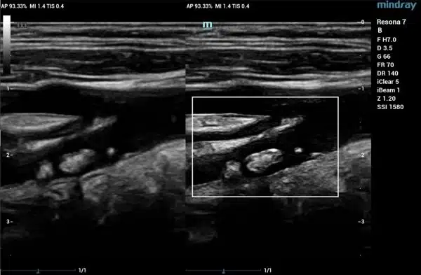 HD-scope-600x393.jpg