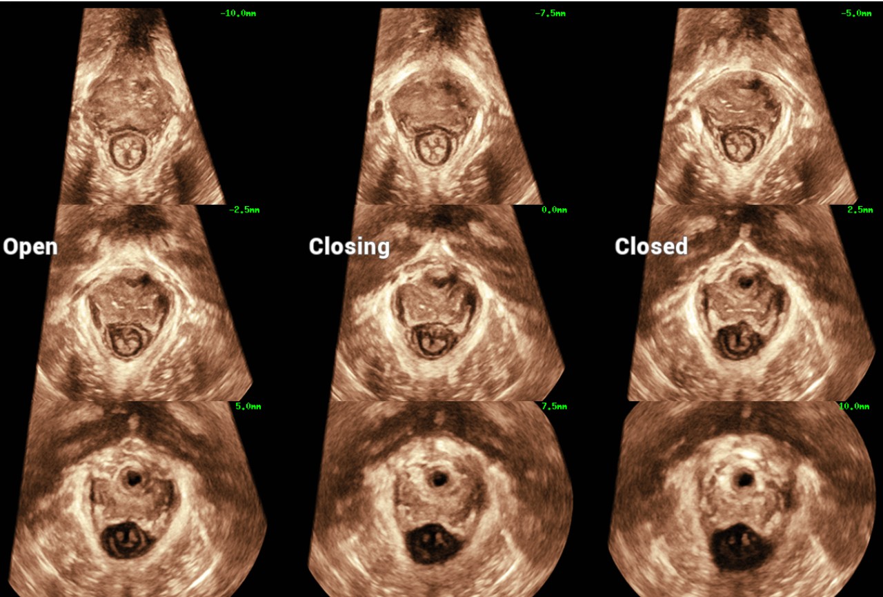 Urogynecology