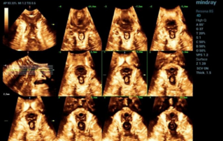 Ultrasound Journal 2 - 분만 후 거근 손상